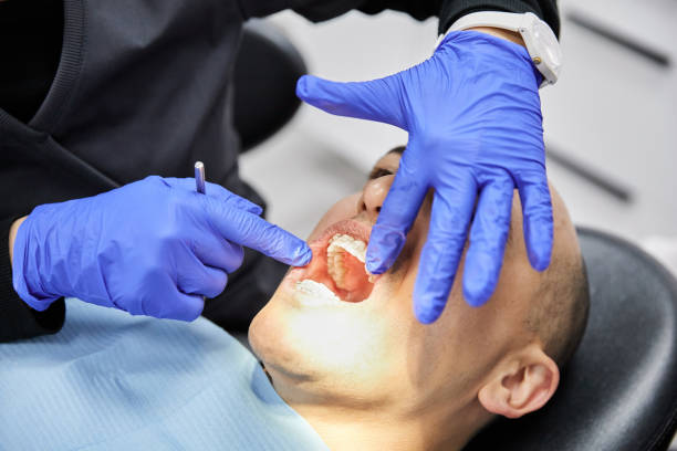 Best Knocked-Out Tooth (Avulsed Tooth) Treatment in University, MS
